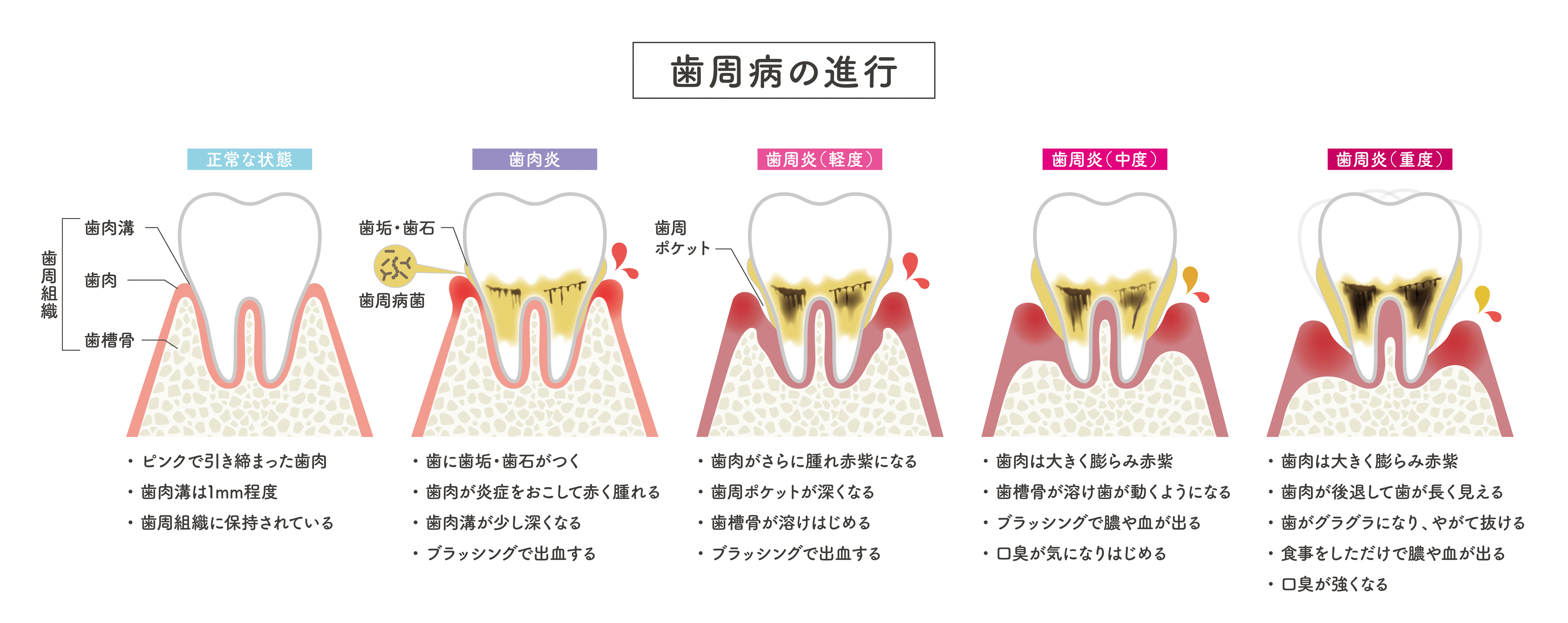 虫歯治療・根幹治療
